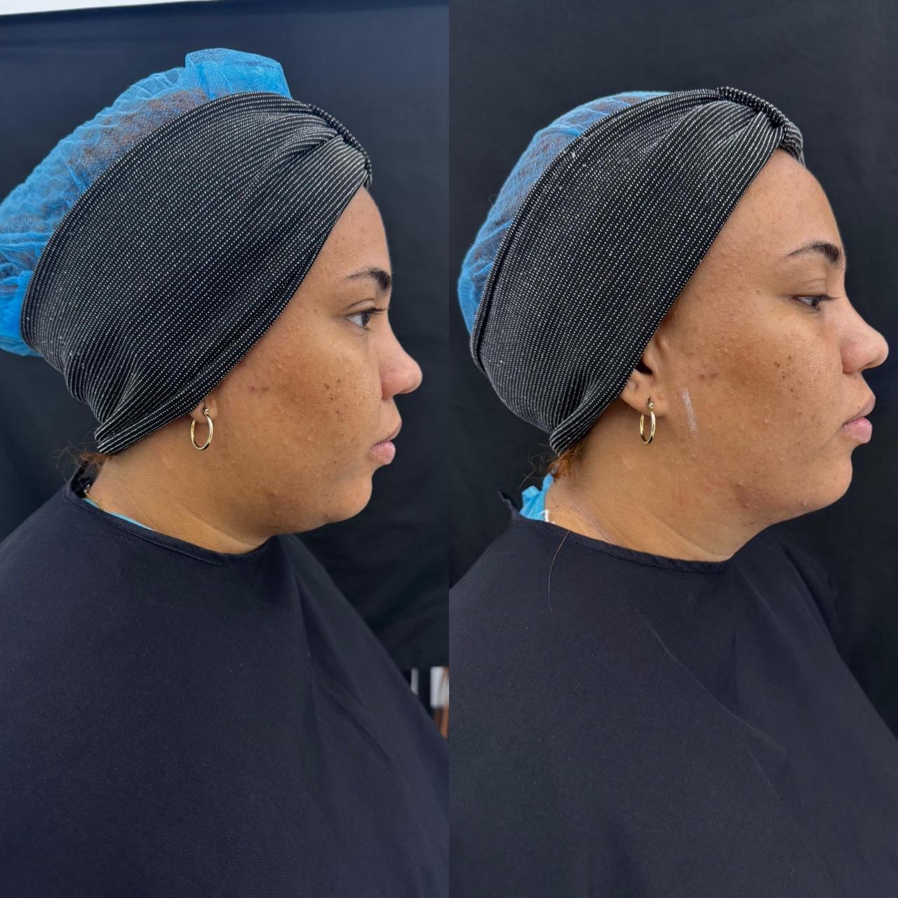 Facial profile comparison showing contour refinement