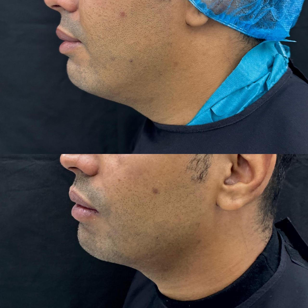 Male neck and jawline comparison image