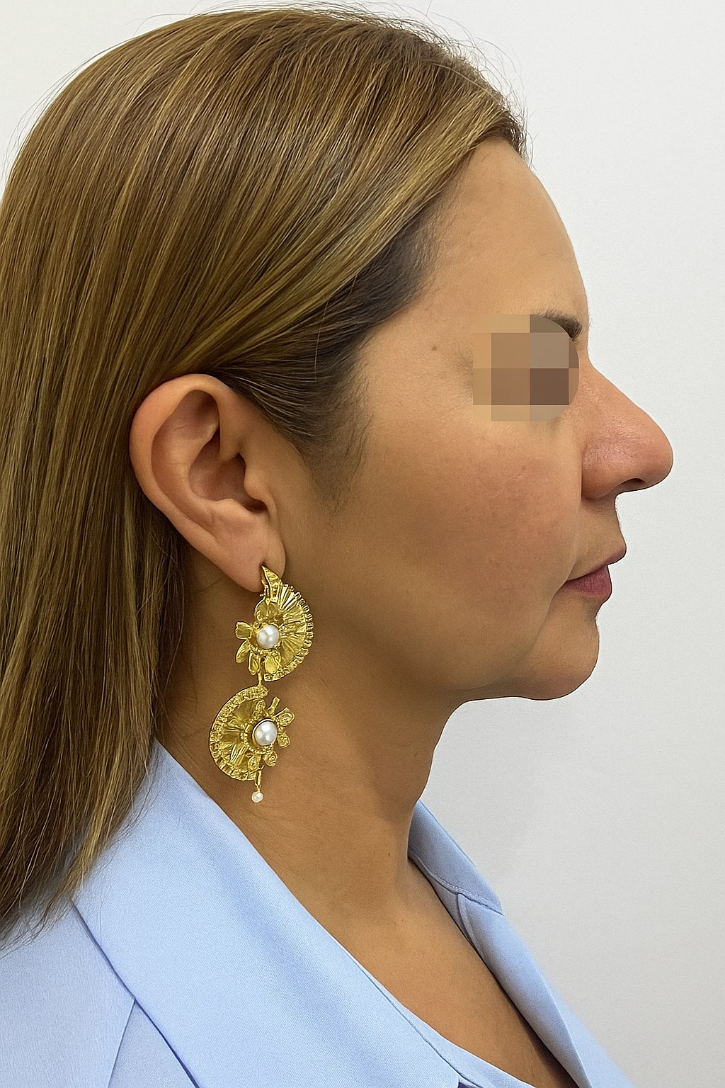 After side profile image showing face and neck contour refinement