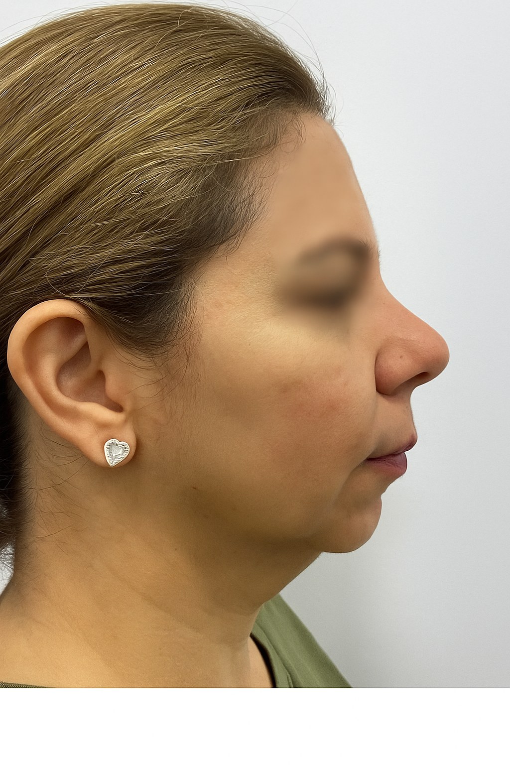 Before side profile image for face and neck contour reference